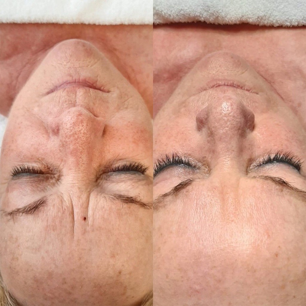 MICRONEEDLING Hét